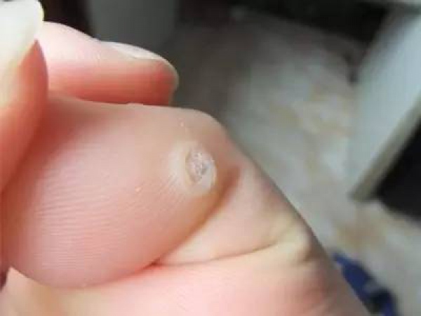清凉油抹在肛门处……效果竟这般神奇！