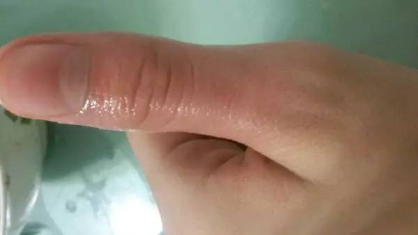 清凉油抹在肛门处……效果竟这般神奇！