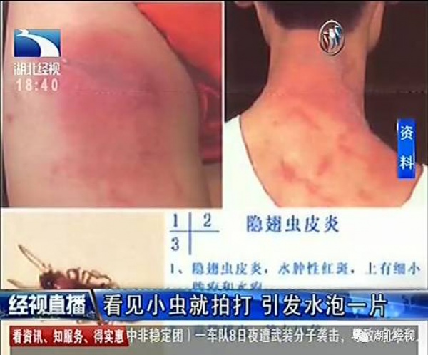 警报！厦门女大学生睡梦中脸痒挠了下，醒来进医院！这危险高发，已有人毁容